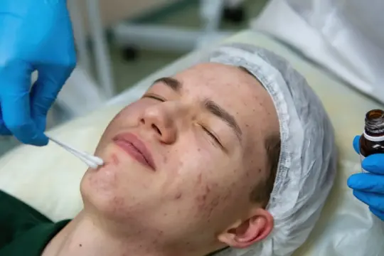 Effective Strategies on How to Prevent Acne in 2024 and Beyond